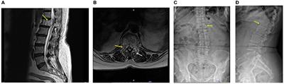 Unilateral Biportal Endoscopic Tumor Removal and Percutaneous Stabilization for Extradural Tumors: Technical Case Report and Literature Review